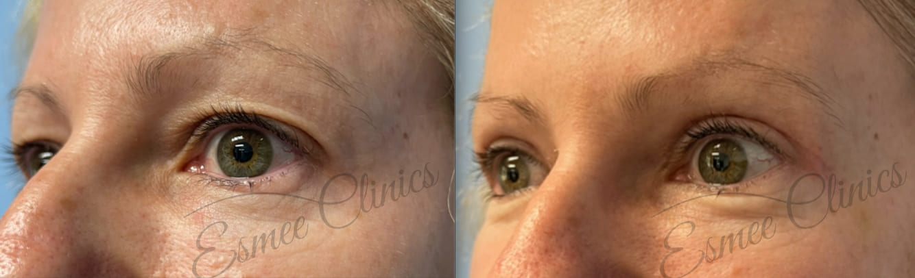 Before and After img